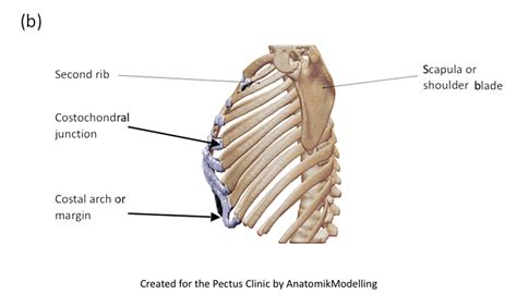 Complex Chest Wall Injury | Rib Injury Clinic