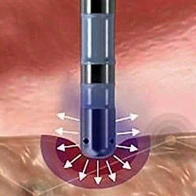 In Layman’s Terms: What is Post-Ablation ‘Recurrence’?Atrial ...