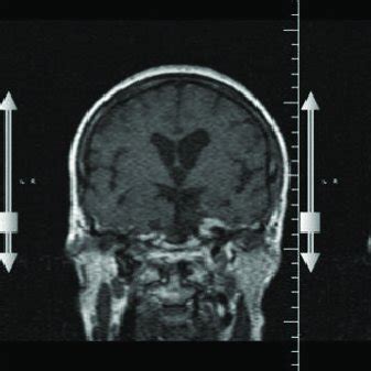 Contrast (Gadolinium) enhanced MRI (T2-weighted) of the patient which ...