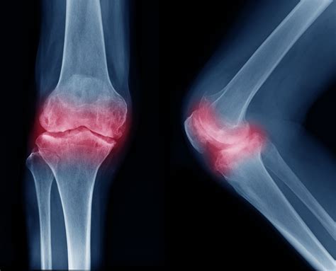 Subchondral Sclerosis: Affected Body Parts and Management