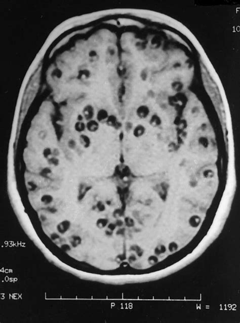 Neurocysticercosis causes, symptoms, diagnosis, treatment & prognosis