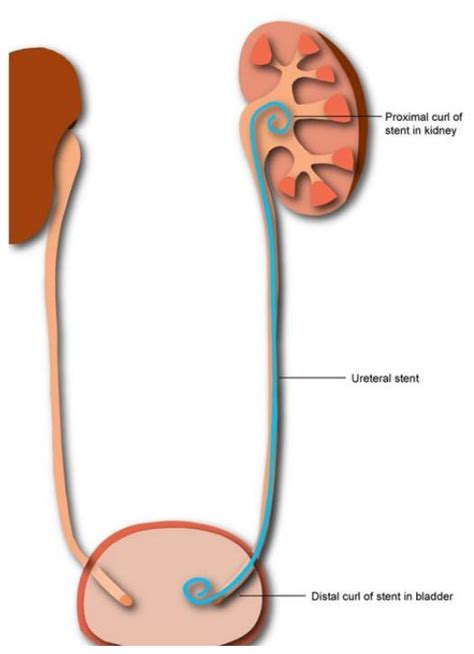 Ureteric Stent - Going home - Milton Keynes University Hospital