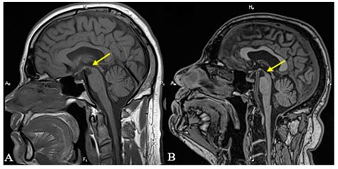 Diagnostics | Free Full-Text | Imaging Criteria for the Diagnosis of Progressive Supranuclear ...