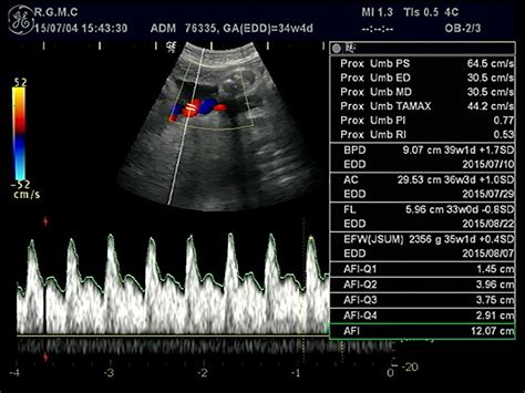 Umbilical Artery Doppler Chart