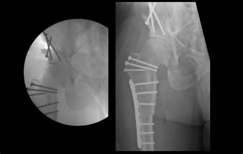 Periacetabular Osteotomy for Complex Structural Hip Deformity ...