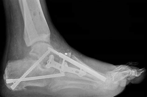 Charcot Reconstruction - Brick Foot and Ankle Center