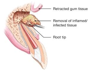 apicoectomy - American Association of Endodontists