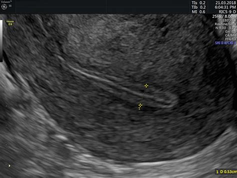 Management of thin endometrium in assisted reproduction: a clinical practice guideline from the ...