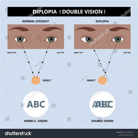 Diplopia Types | atelier-yuwa.ciao.jp