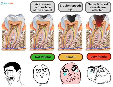 How Do Cavities Form In Teeth? » ScienceABC