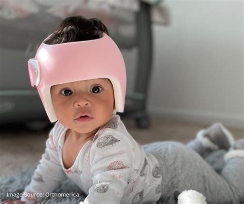 Does My Baby Need A Cranial Remolding Helmet? - Applied Biomechanics Orthotics and Bracing