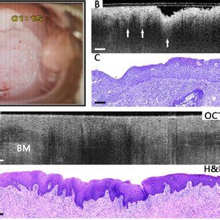 Typical images of HSIL cervical tissues. Colposcopy image (A), OCT... | Download Scientific Diagram