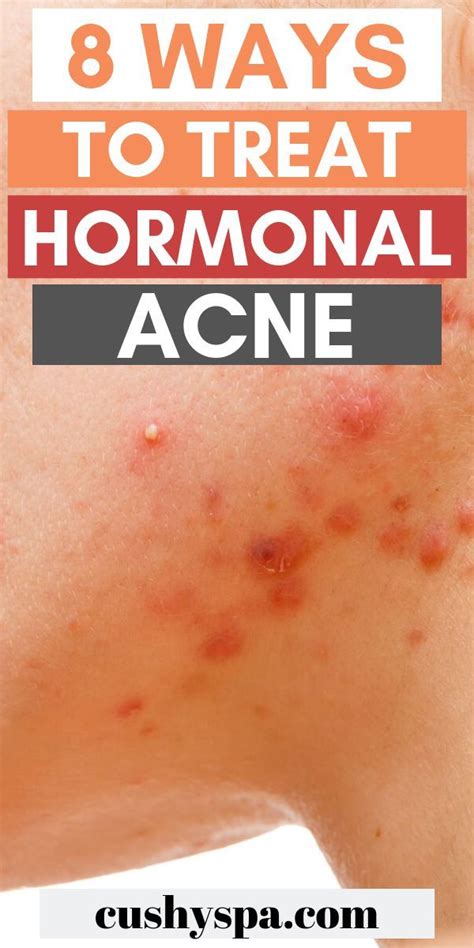 Hormonal acne can be so frustrating to deal with. Try these natural ways to treat acne at home ...