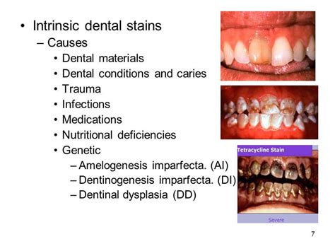 Causes Of Intrinsic Stains On Teeth - TeethWalls