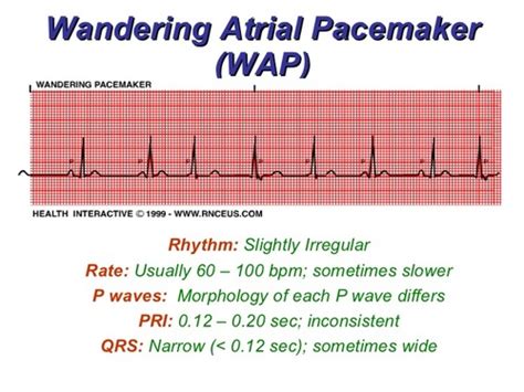 Wandering Atrial Pacemaker