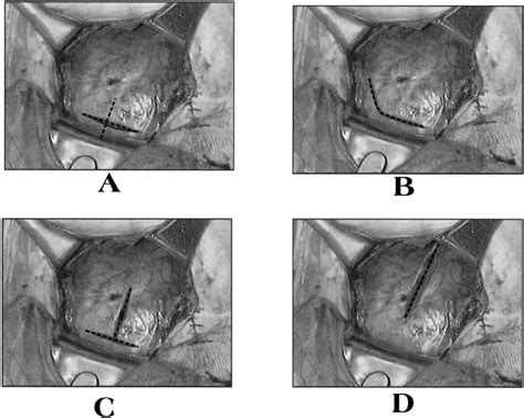 Cesarean Section Incision Types