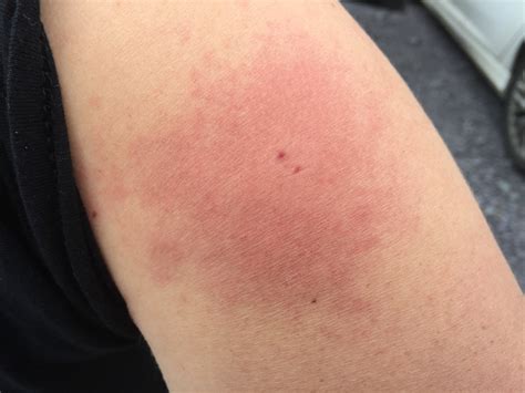 Negative reaction to a Horsefly Bite | HubPages