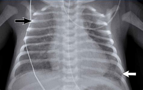 Granular Neonatal Chest X Ray