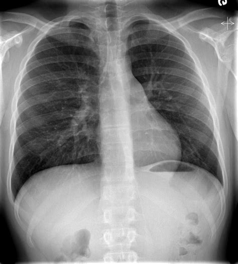 Walking pneumonia chest x ray findings - stormge