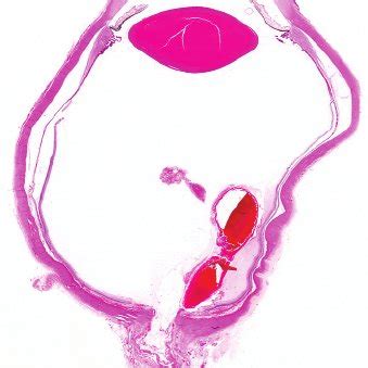 (PDF) Optic nerve avulsion from door-handle trauma in children