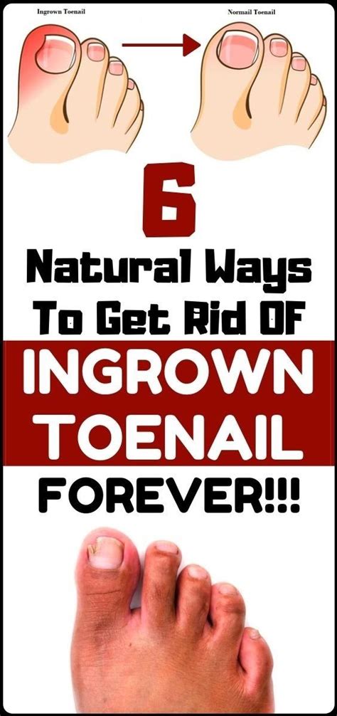 Solve Your Ingrown Toenail With These 6 Natural & Homemade Remedies ...