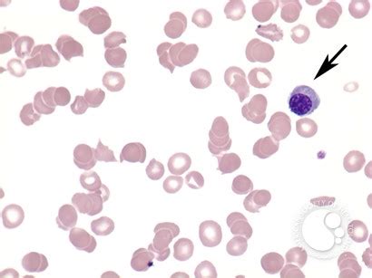 Microangiopathic hemolytic anemia - 1.