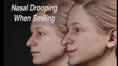 Dynamic Nasal Drooping When Smiling: Cause and Treatment - YouTube