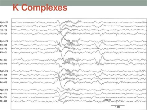 Sleep activity in eeg