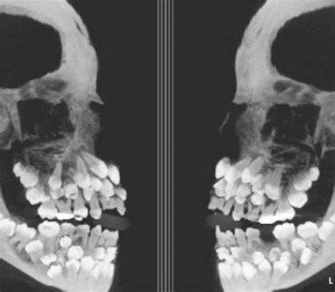 22 Creepy Images You'll Want Nothing to do With. | Hyperdontia, Creepy images, Skull