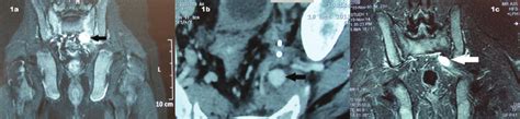 a. Magnetic resonance imaging (MRI) showing contrast enhanced... | Download Scientific Diagram