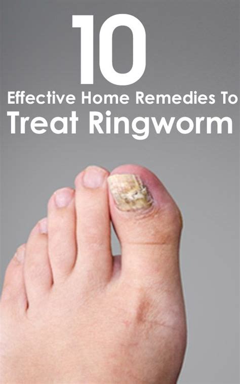 Home Remedies For Ringworms – 10 Ways To Treat The Symptoms | Home ...