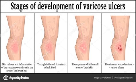 Stages of development of varicose ulcers — Stock Vector © scio21.ukr ...