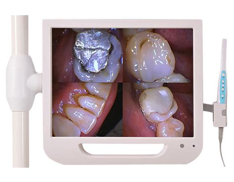 INTRAORAL CAMERA AND SCREEN – Virgin Dental