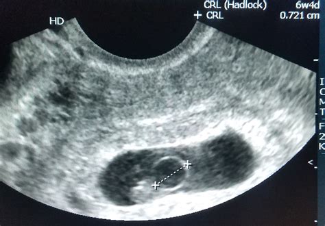 What Causes An Enlarged Yolk Sac In Pregnancy - PregnancyWalls