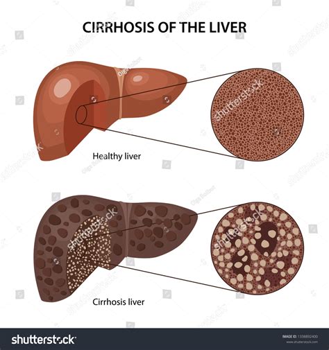 Cirrhosis Liver Histology Healthy Cirrhotic Liver: เวกเตอร์สต็อก (ปลอดค่าลิขสิทธิ์) 1338892400 ...