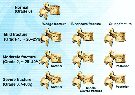 Vertebral fractures | International Osteoporosis Foundation