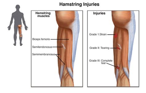 How To Manage Your Hamstring Injury - Sports and Spinal