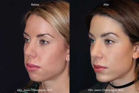 Chin Implant Gallery | Beverly Hills Plastic Surgeon - Dr. Jason Champagne