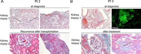 ANCA-Associated Glomerulonephritis in Systemic-Onset Juvenile Idiopathic Arthritis - American ...