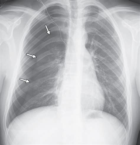 Apical Pneumothorax Chest X Ray | Porn Sex Picture