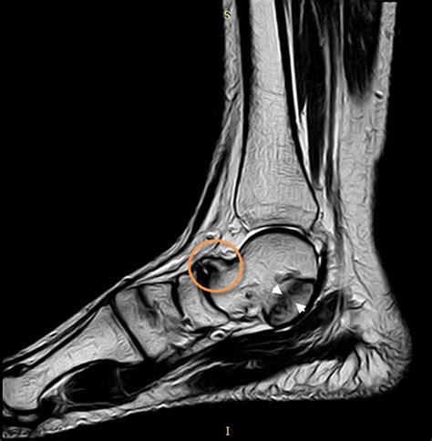 14 best Tarsal Coalition Information images on Pinterest | Surgery ...