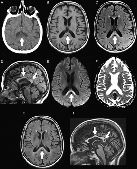 An MRI review of acquired corpus callosum lesions | Journal of ...