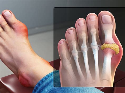 Gout in big toe: How to identify, causes, and treatment