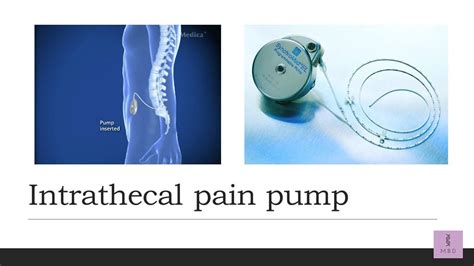 Intrathecal Pain Pump: What is it used for? - My Biology Dictionary