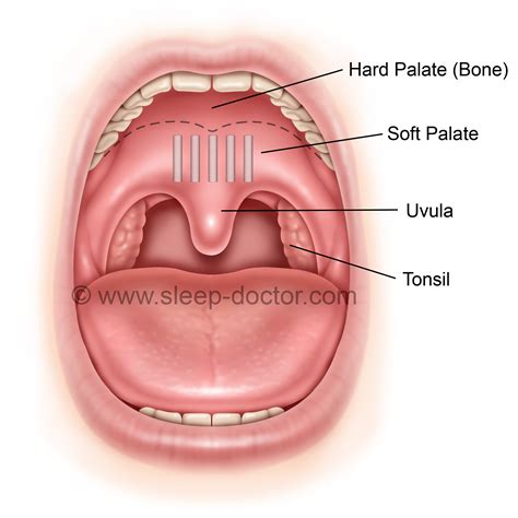 Pillar Procedure - Sleep Doctor