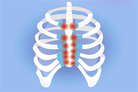 Costochondritis and Arthritis: Understanding Symptoms and Treatment