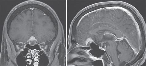 Planum sphenoidale meningioma – upfront radiosurgery | Radiology Key