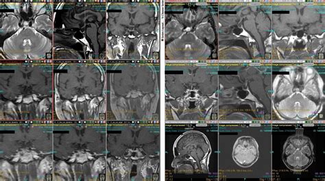 Dynamic pituitary mri protocol. Pituitary gland protocol (MRI). 2022-10-13