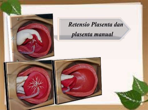 RETENSIO PLASENTA