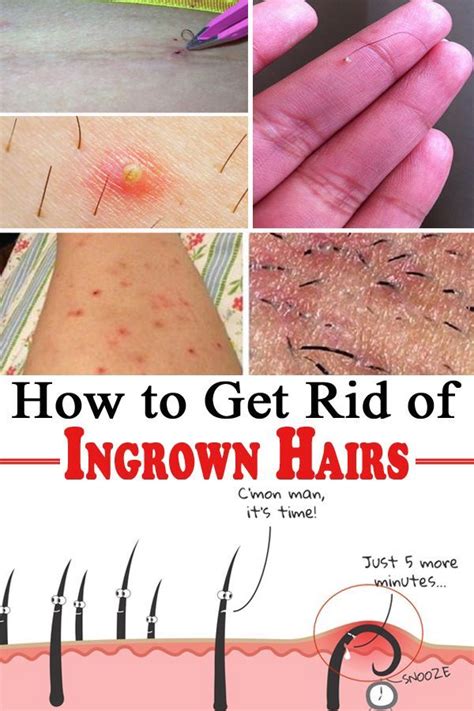 How to Get Rid of Ingrown Hairs #IngrownHairSerum | Ingrown hair ...